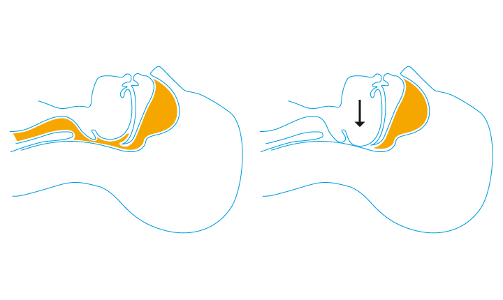 Freie Atemwege auf dem Bild links und verschlossene Atemwege bei Schlafapnoe auf dem Bild rechts.